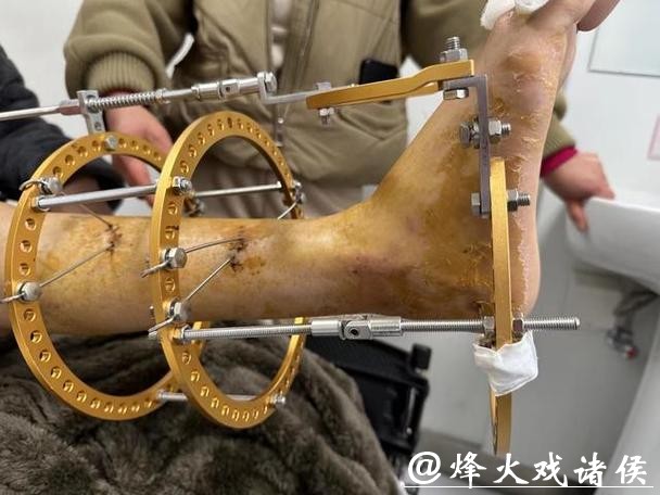 拜仁中场托利索接受脚踝手术 拜仁中场托利索接受脚踝手术