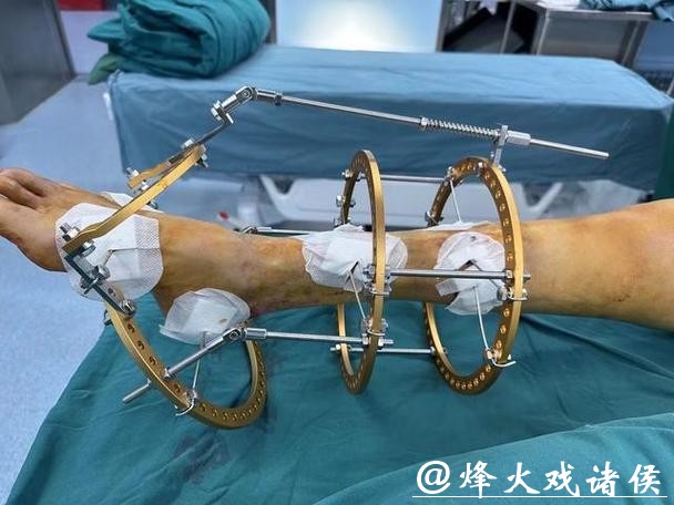 拜仁中场托利索接受脚踝手术 拜仁中场托利索接受脚踝手术